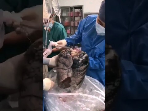 Best Lungs Detox.. #drrobin #lungs #swasthy #dietfood #health #food #Detox #healthfood #facts Best Lungs Detox.. #drrobin #lungs #swasthy #dietfood #health #food #Detox #healthfood #facts