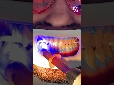 Teeth whitening process Teeth whitening process