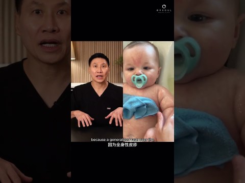 Dr. Thean React: Breastmilk as an eczema treatment | Ensoul Medical Clinic Dr. Thean React: Breastmilk as an eczema treatment | Ensoul Medical Clinic