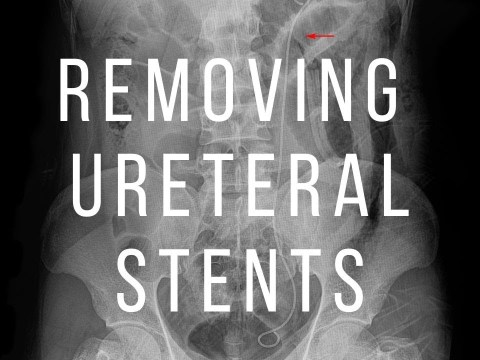 Removing Ureteral Stent in 15 Seconds #shorts Removing Ureteral Stent in 15 Seconds #shorts