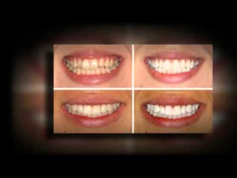 Teeth Whitening Home Remedies for Whiter Teeth Teeth Whitening Home Remedies for Whiter Teeth