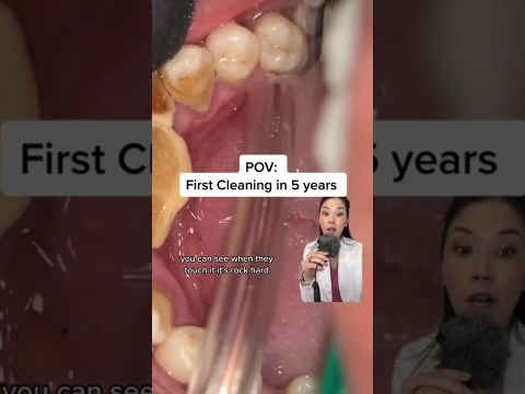 5 years of plaque build up. Get your cleanings! #plaque #tartar #buildip #dentist #dentistry 5 years of plaque build up. Get your cleanings! #plaque #tartar #buildip #dentist #dentistry