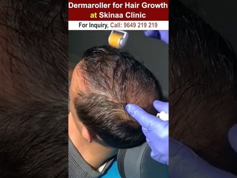 Dermaroller for hair growth #dermaroller #dermarollerforhairgrowth #hairgrowth #dermarollerforhair Dermaroller for hair growth #dermaroller #dermarollerforhairgrowth #hairgrowth #dermarollerforhair