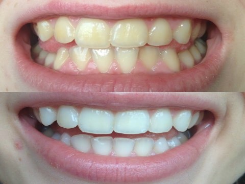 How I whitened my VERY yellow teeth! (WORKS!) BEFORE AND AFTER! How I whitened my VERY yellow teeth! (WORKS!) BEFORE AND AFTER!