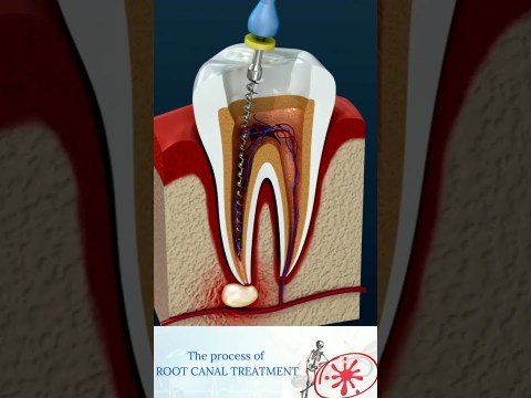 Root Canal Treatment & Tooth Abscess Root Canal Treatment & Tooth Abscess