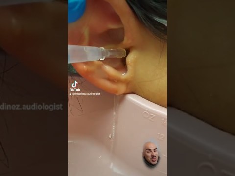 Earwax removal…. What did I just remove? Is it a large piece of wax or sometype of animal? Earwax removal…. What did I just remove? Is it a large piece of wax or sometype of animal?