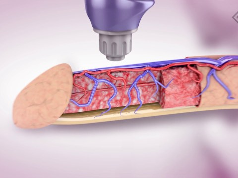 Erectile Dysfunction Treatment – BTL Shockwave Therapy Erectile Dysfunction Treatment – BTL Shockwave Therapy