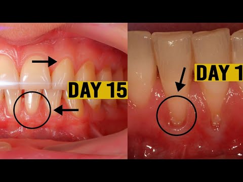 Grow Back Your Receding Gums In Just 2 Week Say Goodbye to Receding Gums Grow Back Your Receding Gums In Just 2 Week Say Goodbye to Receding Gums