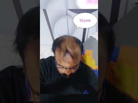hair regrowth 4 months result without hair transplant hair regrowth 4 months result without hair transplant