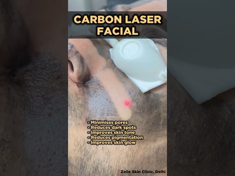 Skin Glow Laser | Carbon Laser Facial | Carbon Laser Treatment | Carbon Peel | Skin Clinic Delhi Skin Glow Laser | Carbon Laser Facial | Carbon Laser Treatment | Carbon Peel | Skin Clinic Delhi