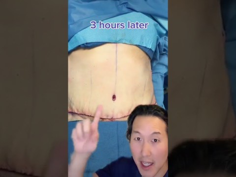 How I Remove Skin After Massive Weight Loss! #shorts #abdominoplasty How I Remove Skin After Massive Weight Loss! #shorts #abdominoplasty