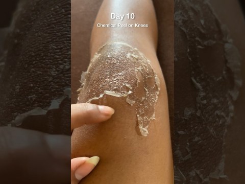 Chemical peel on knees Day 10 #chemicalpeel #chemicalpeeling #chemicalpeeljourney #tcapeel #peels Chemical peel on knees Day 10 #chemicalpeel #chemicalpeeling #chemicalpeeljourney #tcapeel #peels