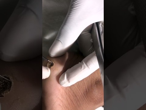 Warts Removal Treatment | Safe and Effective Wart Removal Treatment | Skinaa Clinic #viral #ytshorts Warts Removal Treatment | Safe and Effective Wart Removal Treatment | Skinaa Clinic #viral #ytshorts