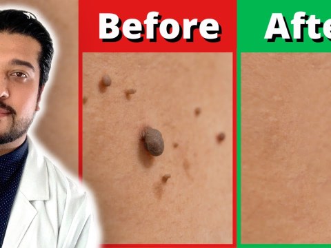 How to Rid Skin Tags FASTER | 3 Easy Skin Tag Removal Steps How to Rid Skin Tags FASTER | 3 Easy Skin Tag Removal Steps