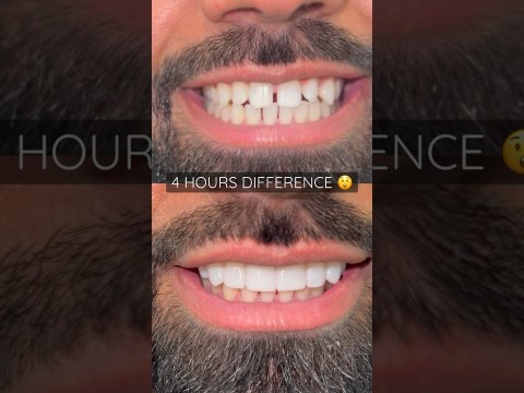 Composite bonding by Dr. Sulley #cosmeticdentistry #ruhdental Composite bonding by Dr. Sulley #cosmeticdentistry #ruhdental