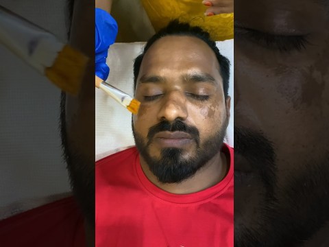 chemical peeling treatment #skincare #adoreskinclinic #shorts chemical peeling treatment #skincare #adoreskinclinic #shorts