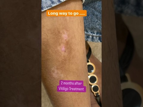 Vitiligo Treatment in Chandigarh| Dermatologistinchandigarh chandigarh #shorts Vitiligo Treatment in Chandigarh| Dermatologistinchandigarh chandigarh #shorts