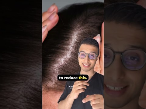 How to treat female Hair Pattern | Dr. Sarin | How to treat female Hair Pattern | Dr. Sarin |