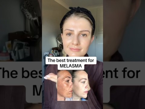 The best treatment for melasma! #skincare #skinadvice #skincaretips #hyperpigmentationtreatment The best treatment for melasma! #skincare #skinadvice #skincaretips #hyperpigmentationtreatment