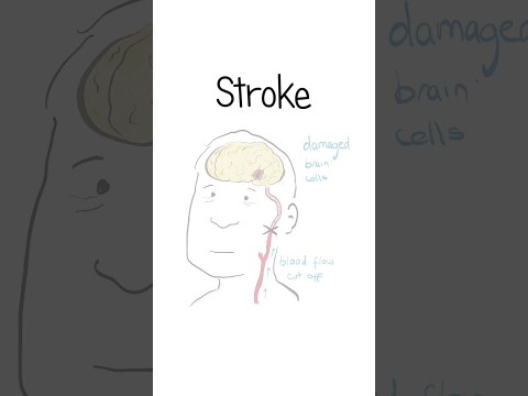 Strokes Explained #healthsketch #shorts Strokes Explained #healthsketch #shorts