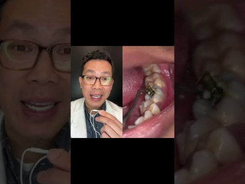 What is this Hole in this Person Tooth? What is this Hole in this Person Tooth?