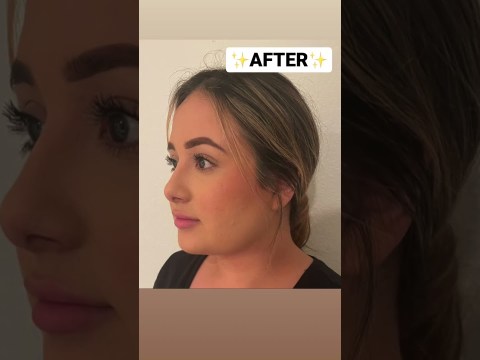 Buccal fat removal and chin liposuction combo procedure! AMAZING #beforeandafter #weightloss Buccal fat removal and chin liposuction combo procedure! AMAZING #beforeandafter #weightloss