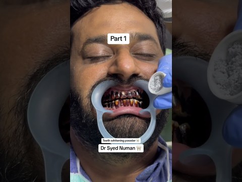 Teeth whitening powder #dentistteeth #teethwhiteningproducts #doctor #toothdental #teethwhitening # Teeth whitening powder #dentistteeth #teethwhiteningproducts #doctor #toothdental #teethwhitening #