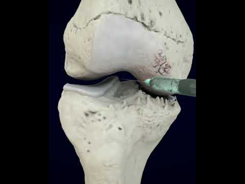 The best treatment for Knee Arthritis The best treatment for Knee Arthritis