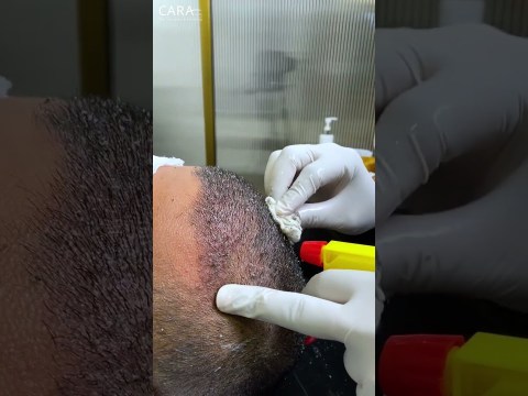 First Shampoo Headwash after Hair Transplant | Cara Clinic First Shampoo Headwash after Hair Transplant | Cara Clinic