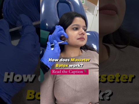 "Transformative beauty: Masseter Botox redefines facial proportions by relaxing the jaw muscles." "Transformative beauty: Masseter Botox redefines facial proportions by relaxing the jaw muscles."