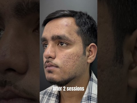 Best acne scar treatment in india #acnescars #acnescarsremoval #acnescarstreatment Best acne scar treatment in india #acnescars #acnescarsremoval #acnescarstreatment