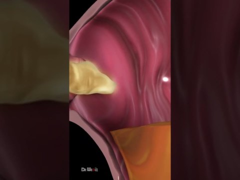 What Is Acid Reflux (Animation) What Is Acid Reflux (Animation)