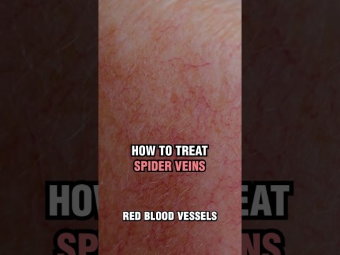 How to treat spider veins and broken capillaries? How to treat spider veins and broken capillaries?