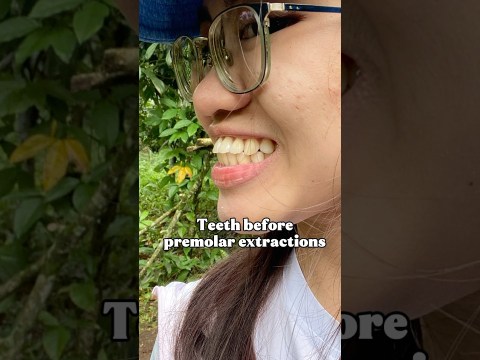 Premolar Extractions Before and After #dentalshorts #youtubeshorts #shorts #braces #viral Premolar Extractions Before and After #dentalshorts #youtubeshorts #shorts #braces #viral