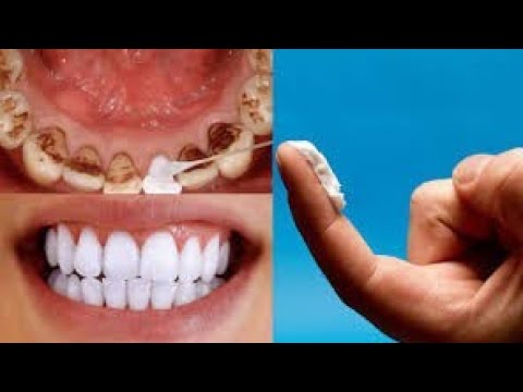 Snow Teeth Whitening Review At Home & Remove Dental Plaque Without Going To The Dentist Snow Teeth Whitening Review At Home & Remove Dental Plaque Without Going To The Dentist