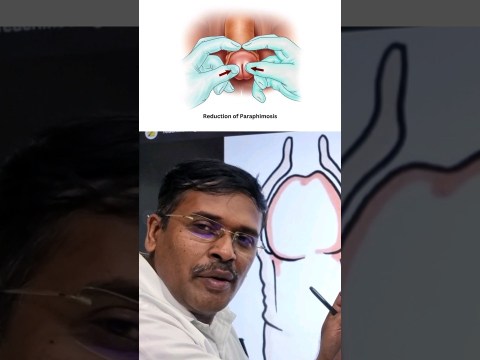 ஆண்குறி முன் தோல் பிரச்சினைகள் !? #doctorkarthikeyan ஆண்குறி முன் தோல் பிரச்சினைகள் !? #doctorkarthikeyan