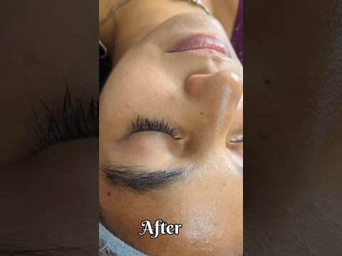 Hydra facial skin brightening treatment at soul tree #skinwhiteningfacial #tamil Hydra facial skin brightening treatment at soul tree #skinwhiteningfacial #tamil