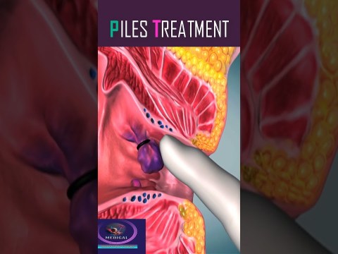 Piles Treatment #shorts #piles Piles Treatment #shorts #piles