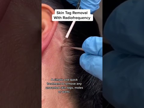Skin Tag Removal With Radiofrequency | Quick & Safe Treatment DRMEDISPA Skin Tag Removal With Radiofrequency | Quick & Safe Treatment DRMEDISPA