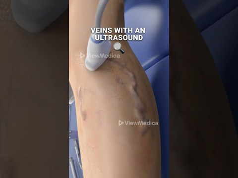 Super glue for your veins? (3D Animation) Super glue for your veins? (3D Animation)