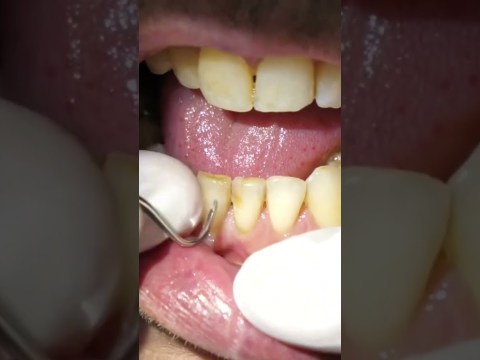 smoker’s teeth dental cleaning #shorts smoker’s teeth dental cleaning #shorts