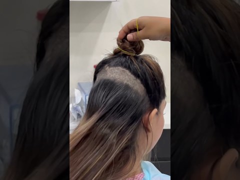 Female hair transplant | Dadu Medical Centre | Dr. Nandni Daddu Female hair transplant | Dadu Medical Centre | Dr. Nandni Daddu