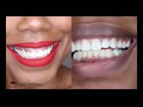 Teeth whitening home remedies Teeth whitening home remedies