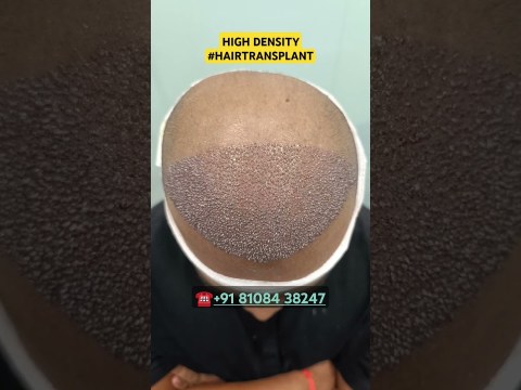 Hair Loss Treatment #hair #hairloss #hairlosstreatment #ytshorts #alopecia #hairtransplant #hairfall Hair Loss Treatment #hair #hairloss #hairlosstreatment #ytshorts #alopecia #hairtransplant #hairfall
