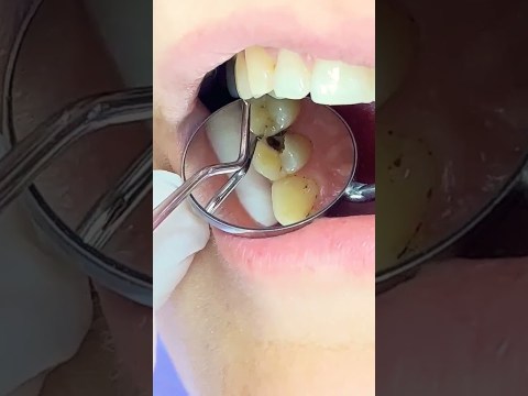 Tooth Decay Removal #toothdecay #toothache #dentalclinic #klinikedentaretirane Tooth Decay Removal #toothdecay #toothache #dentalclinic #klinikedentaretirane