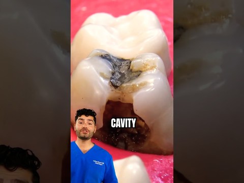Dentist Explains: How To Fix A Cavity !? Dentist Explains: How To Fix A Cavity !?