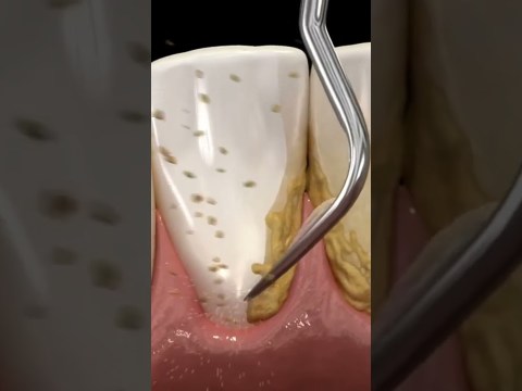 cleaning teeth with ultrasonic scaler #shorts #dentist #teethcleaning cleaning teeth with ultrasonic scaler #shorts #dentist #teethcleaning