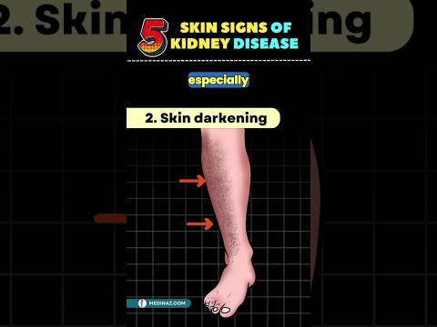 5 Weird Skin Signs of Kidney Disease | Chronic Kidney Disease #shortsfeed #kidney #kidneydisease 5 Weird Skin Signs of Kidney Disease | Chronic Kidney Disease #shortsfeed #kidney #kidneydisease