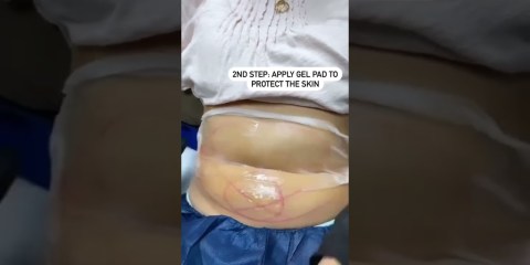 Cool Sculpting for the Tummy in Action!! #shorts Cool Sculpting for the Tummy in Action!! #shorts