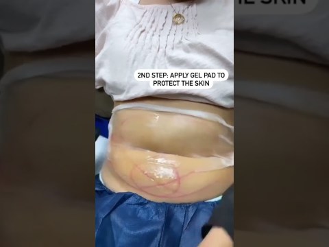 Cool Sculpting for the Tummy in Action!! #shorts Cool Sculpting for the Tummy in Action!! #shorts